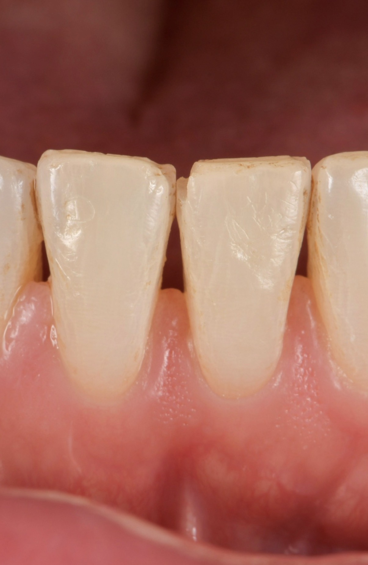 Anonymized dental imagine included for educational illustration